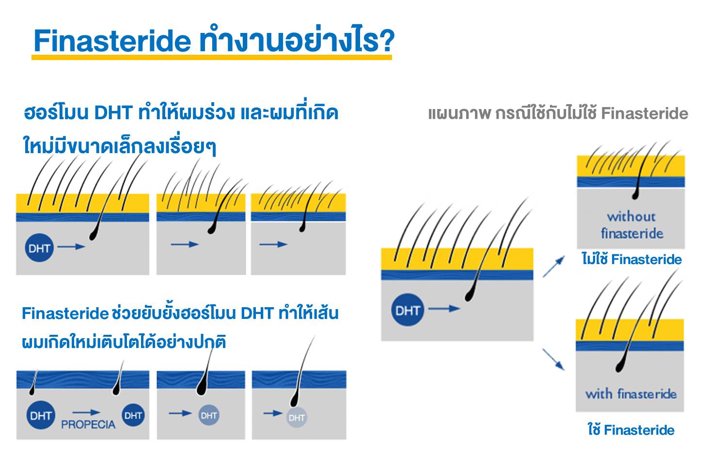 Finasteride (ฟีแนสเทอไรด์) ทำงานอย่างไร, ภาพขั้นตอนการทำงานของ Finasteride (ฟีแนสเทอไรด์), Finasteride, ฟีแนสเทอไรด์, ยาปลูกผม