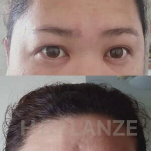 ผลการใช้ เซรั่มปลูกผม H Balanze Serum